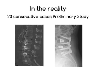 In the reality
20 consecutive cases Preliminary Study
 