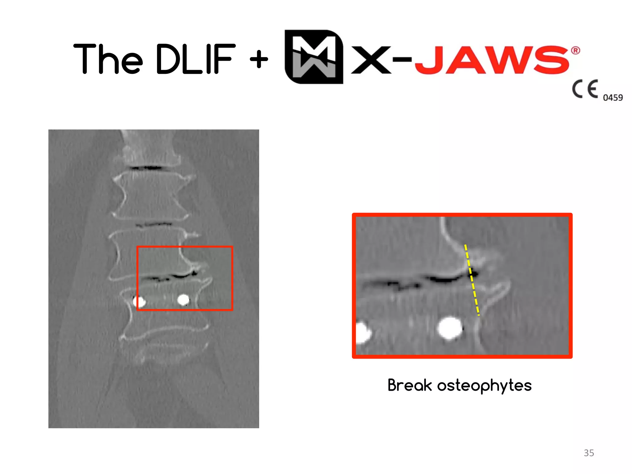 Lateral Lumbar Interbody Fusion : DLIF, XLIF with Lateral Fixation in ...