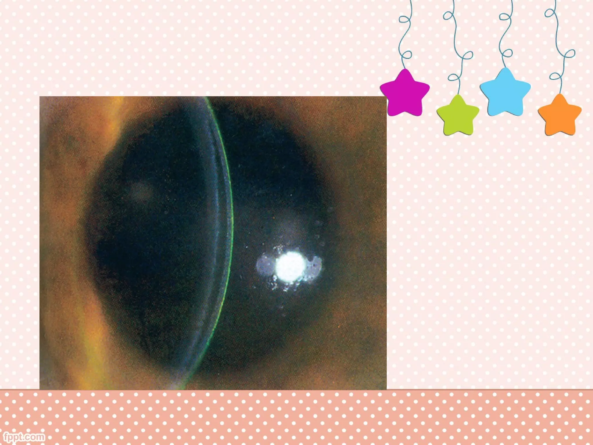 Diffuse Lamellar Keratitis (DLK) | PPT