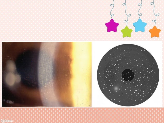 Diffuse Lamellar Keratitis (DLK) | PPT | Eye and Vision Conditions ...