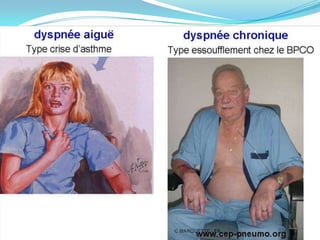 *Cardio-vasculaire: marbrures, hypotension, paleurs,
  extrémités froides, collapsus(PAS<90mmhg),
  tachycardie >120/mn, pouls paradoxal voire arrêt C-V.
* Neuropsychologique: score de Glascow, agitation,
  angoisse, troubles de la conscience voire coma.
 