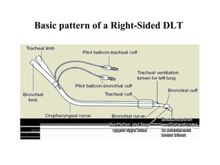 Basic pattern of a Right-Sided DLT
 