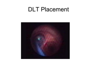 DLT Placement
 