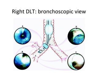 Right DLT: bronchoscopic view
 