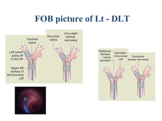 FOB picture of Lt - DLT
 
