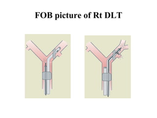 FOB picture of Rt DLT
 