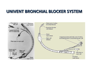 UNIVENT BRONCHIAL BLOCKER SYSTEMUNIVENT BRONCHIAL BLOCKER SYSTEM
 