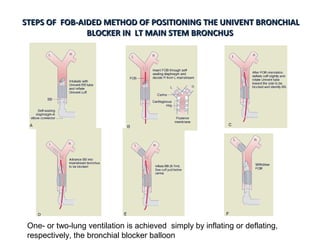 STEPS OF FOB-AIDED METHOD OF POSITIONING THE UNIVENT BRONCHIALSTEPS OF FOB-AIDED METHOD OF POSITIONING THE UNIVENT BRONCHIAL
BLOCKER IN LT MAIN STEM BRONCHUSBLOCKER IN LT MAIN STEM BRONCHUS
One- or two-lung ventilation is achieved simply by inflating or deflating,
respectively, the bronchial blocker balloon
 