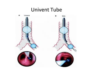 Univent Tube
 