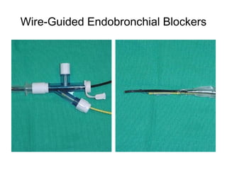 Wire-Guided Endobronchial Blockers
 