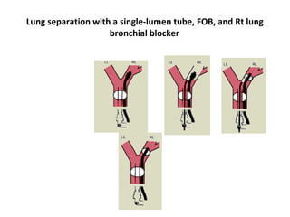 Lung separation with a single-lumen tube, FOB, and Rt lung
bronchial blocker
 