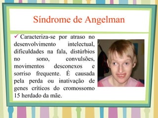 Síndrome de Angelman 
 Caracteriza-se por atraso no 
desenvolvimento intelectual, 
dificuldades na fala, distúrbios 
no sono, convulsões, 
movimentos desconexos e 
sorriso frequente. É causada 
pela perda ou inativação de 
genes críticos do cromossomo 
15 herdado da mãe. 
 