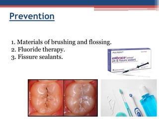Prevention
1. Materials of brushing and flossing.
2. Fluoride therapy.
3. Fissure sealants.
 