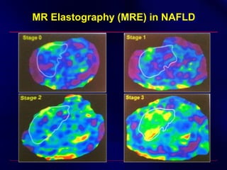 MR Elastography (MRE) in NAFLD
 