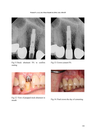 Watted N. et al., Int J Dent Health Sci 2014; 1(4): 430-435 
Fig.11:Stock abutment PA to confirm 
seating 
Fig.12: View of prepped stock abutment in 
mouth 
Fig.13: Crown cement PA 
Fig.14: Final crown the day of cementing 
180 
