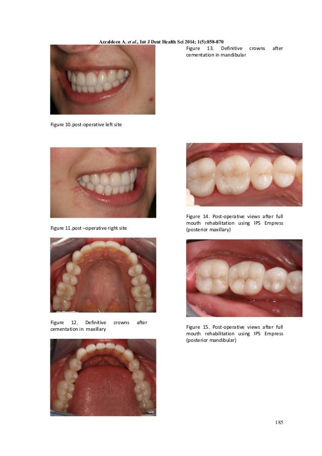 PROSTHODONTIC MANAGEMENT OF PATIENTS WITH AMELOGENESIS IMPERFECTA A