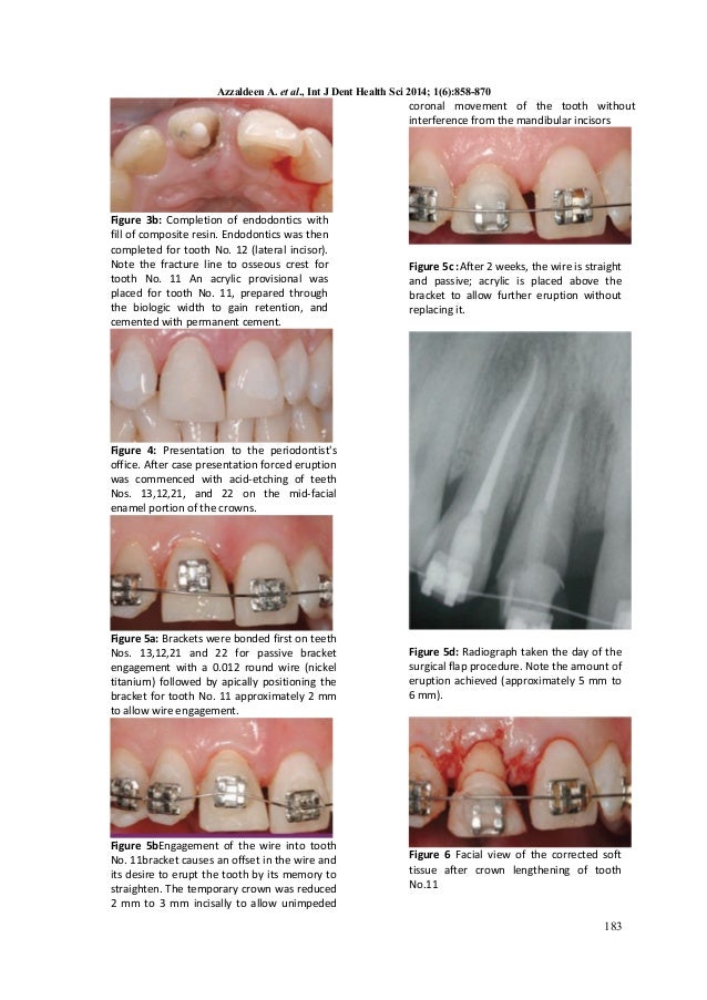 THE ART AND SCIENCE OF TREATMENT PLANNING ON ORTHODONTIC EXTRUSION