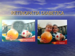 RETINOPATIA DIABETICA 