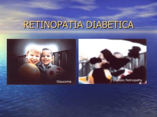 RETINOPATIA DIABETICA 