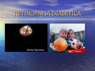 RETINOPATIA DIABETICA 