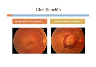 DMAE seca o no exudativa DMAE húmeda o exudativa
Clasificación
 