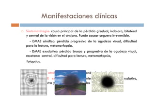 Manifestaciones clínicas
Sintomatología: causa principal de la pérdida gradual, indolora, bilateral
y central de la visión en el anciano. Puede causar ceguera irreversible.
- DMAE atrófica: pérdida progresiva de la agudeza visual, dificultad
para la lectura, metamorfopsia.
- DMAE exudativa: pérdida brusca y progresiva de la agudeza visual,
escotoma central, dificultad para lectura, metamorfopsia,
fotopsias.
Clínica DMAE atrófica: hallazgos en el fondo de ojo de drusas.
Clínica DMAE exudativa: desprendimiento de la retina exudativo,
hemorragias intra y subretiniana, exudados lipídicos.
 