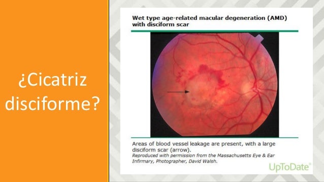 Degeneración Macular Asociada a la Edad.