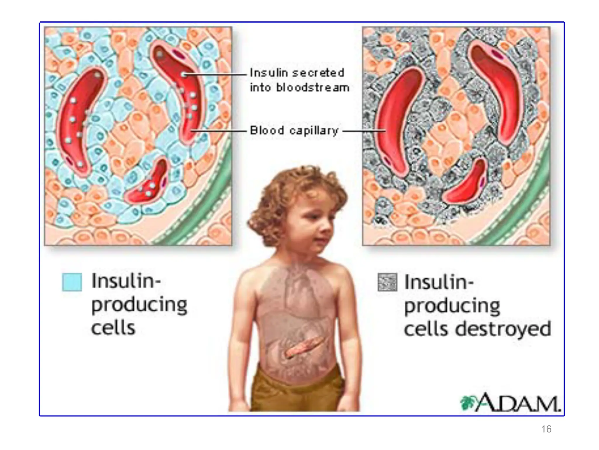 Endocrine pathology ( diabetes mellitus and thyroid gland ) | PPT