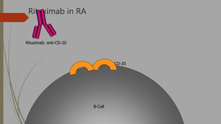 Rituximab in RA
B-Cell
CD-20
Rituximab: anti-CD-20
 