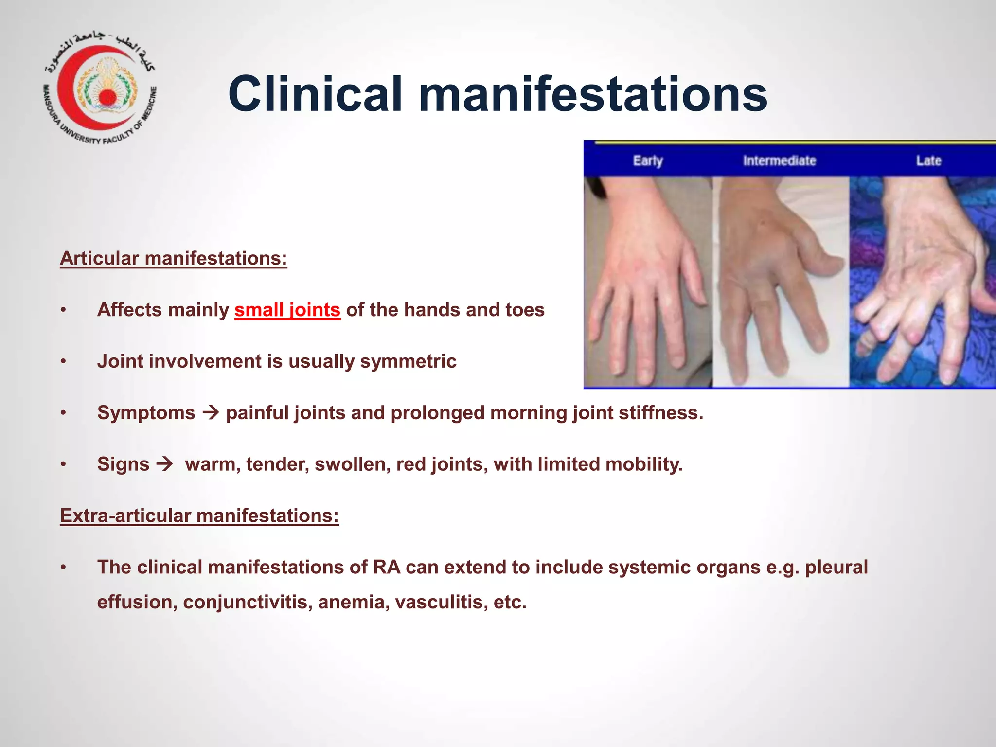 Clinical manifestations
Articular manifestations:
• Affects mainly small joints of the hands and toes
• Joint involvement is usually symmetric
• Symptoms  painful joints and prolonged morning joint stiffness.
• Signs  warm, tender, swollen, red joints, with limited mobility.
Extra-articular manifestations:
• The clinical manifestations of RA can extend to include systemic organs e.g. pleural
effusion, conjunctivitis, anemia, vasculitis, etc.
 