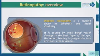 Dr.
Majdi
AlJasim
Retinopathy: overview
Diabetic retinopathy is a leading
cause of blindness and visual
disability.
It is caused by small blood vessel
damage to the back layer of the eye,
the retina, leading to progressive loss
of vision, even blindness.
 
