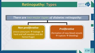 Dr.
Majdi
AlJasim
There are two major types of diabetes retinopathy:
Non-proliferative
(micro-aneurysm → leakage →
hard and soft exudate and dot
hemorrhage)
Proliferative
(formation of new blood vessels
→ rupture → bleeding)
Retinopathy: Types
 