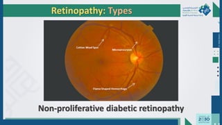 Dr.
Majdi
AlJasim
Retinopathy: Types
Non-proliferative diabetic retinopathy
 