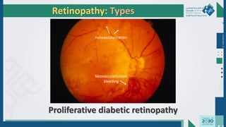 Dr.
Majdi
AlJasim
Retinopathy: Types
Proliferative diabetic retinopathy
neovascularization
Neovascularization
bleeding
 
