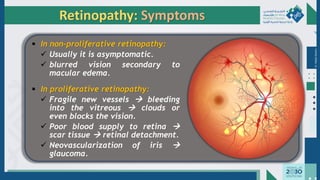 Dr.
Majdi
AlJasim
▪ In non-proliferative retinopathy:
✓ Usually it is asymptomatic.
✓ blurred vision secondary to
macular edema.
▪ In proliferative retinopathy:
✓ Fragile new vessels → bleeding
into the vitreous → clouds or
even blocks the vision.
✓ Poor blood supply to retina →
scar tissue → retinal detachment.
✓ Neovascularization of iris →
glaucoma.
Retinopathy: Symptoms
 
