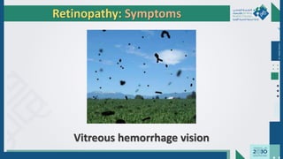 Dr.
Majdi
AlJasim
Retinopathy: Symptoms
Vitreous hemorrhage vision
 