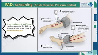 Dr.
Majdi
AlJasim
PAD: screening (Ankle-Brachial Pressure Index)
In asymptomatic patients,
routine screening for PAD by
Ankle-Brachial Index (ABI) is
not recommended.
 