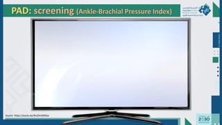 Dr.
Majdi
AlJasim
PAD: screening (Ankle-Brachial Pressure Index)
Source: https://youtu.be/KnJDrmfIXGw
 