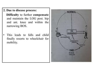 2. Due to disease process:
Difficulty to further compensate
and maintain the LOG post. hip
and ant. knee and within the
narrowing BOS.
• This leads to falls and child
finally resorts to wheelchair for
mobility.
 