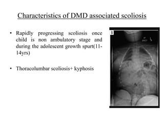 Characteristics of DMD associated scoliosis
• Rapidly progressing scoliosis once
child is non ambulatory stage and
during the adolescent growth spurt(11-
14yrs)
• Thoracolumbar scoliosis+ kyphosis
 