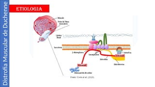 Distrofia Muscular de Duchenne - Slide.pptx