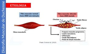 Distrofia Muscular de Duchenne - Slide.pptx