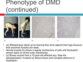 Duchenne Muscular Distrophy | PPT