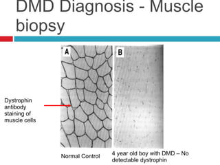 Duchenne Muscular Distrophy | PPT