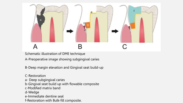 DME deep margin elevation brief ppt.pptx | Oral care | Personal Care