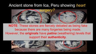 Ancient stone from Ica, Peru showing heart
surgery?
NOTE: These stones are fiercely debated as being fake
because there are many forgeries being made.
However, the originals have patina (weathering) levels that
support their authenticity.
 
