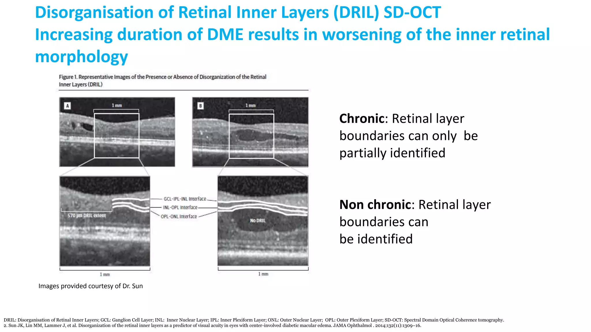 Disorganisation of Retinal Inner Layers (DRIL) SD-OCT
Increasing duration of DME results in worsening of the inner retinal
morphology
Chronic: Retinal layer
boundaries can only be
partially identified
Non chronic: Retinal layer
boundaries can
be identified
DRIL: Disorganisation of Retinal Inner Layers; GCL: Ganglion Cell Layer; INL: Inner Nuclear Layer; IPL: Inner Plexiform Layer; ONL: Outer Nuclear Layer; OPL: Outer Plexiform Layer; SD-OCT: Spectral Domain Optical Coherence tomography.
2. Sun JK, Lin MM, Lammer J, et al. Disorganization of the retinal inner layers as a predictor of visual acuity in eyes with center-involved diabetic macular edema. JAMA Ophthalmol . 2014;132(11):1309–16.
Images provided courtesy of Dr. Sun
 