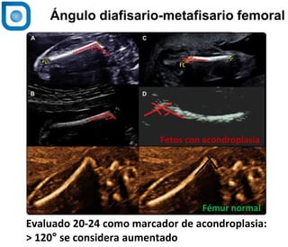 1
Ángulo diafisario-metafisario femoral
Evaluado 20-24 como marcador de acondroplasia:
> 120° se considera aumentado
Fetos con acondroplasia
Fémur normal
 