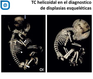 TC helicoidal en el diagnostico
de displasias esqueléticas
OI
 