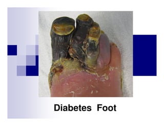 Diabetes Foot

 